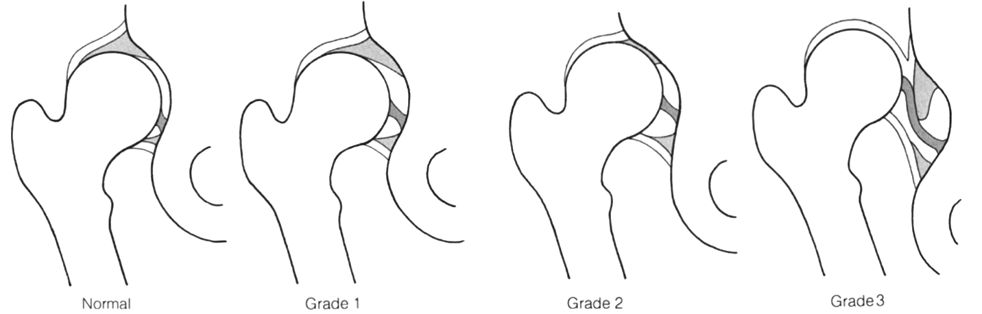 Howarth-Dunn classification