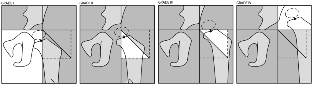 International Hip Dysplasia Institute grading system 2015