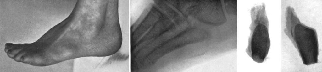 Iselin 1912 Fig 1 2 and 3