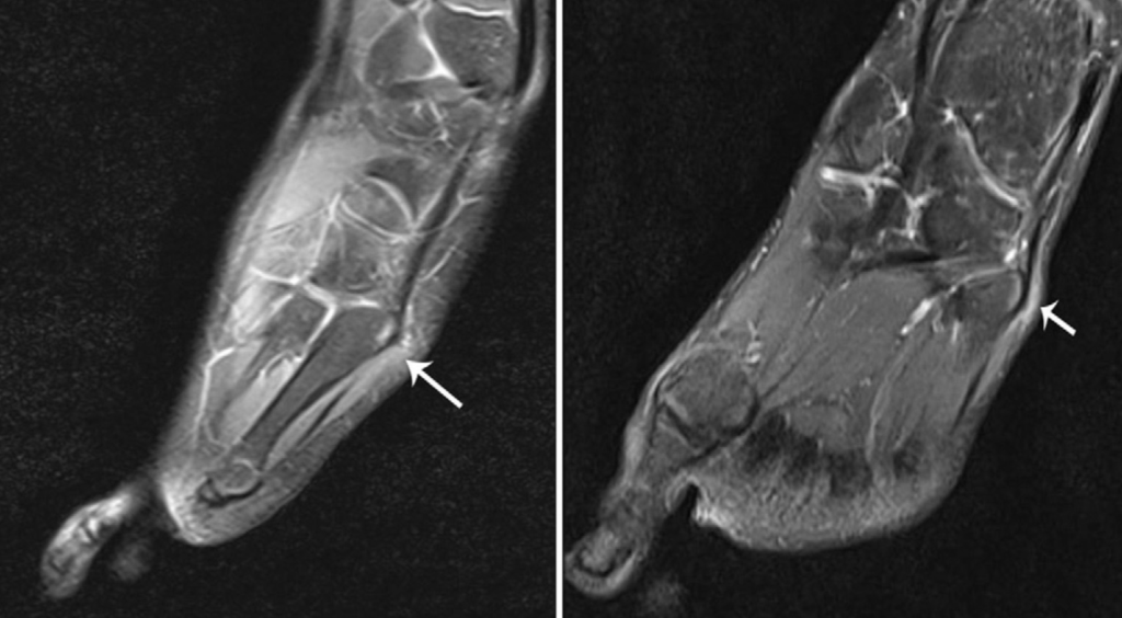 MRI proton density fat suppressed sagittal and coronal images