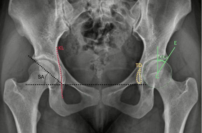 Mature hip pelvic lines and angles labelled