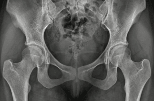 Mature hip pelvic lines and angles