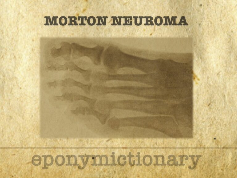 Morton neuroma 680