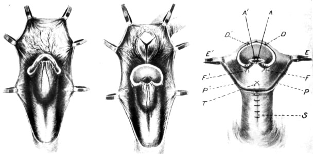 Ombrédanne pouch operation for hypospadias 1933