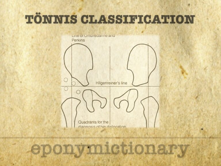 Tönnis classification of DDH 680