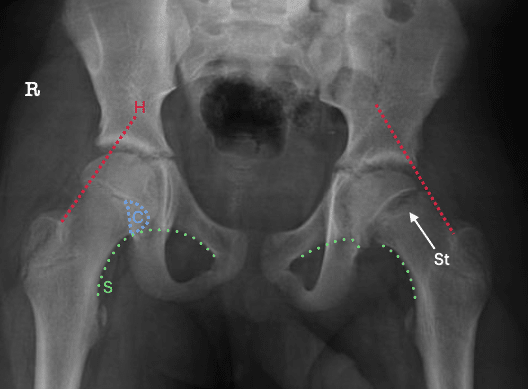 adolescent hip SCFE left label