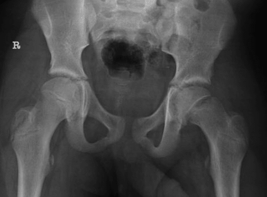 adolescent hip SCFE left