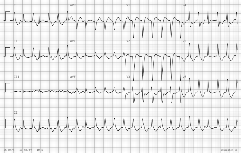 ECG Case 139 dizzy on arrival