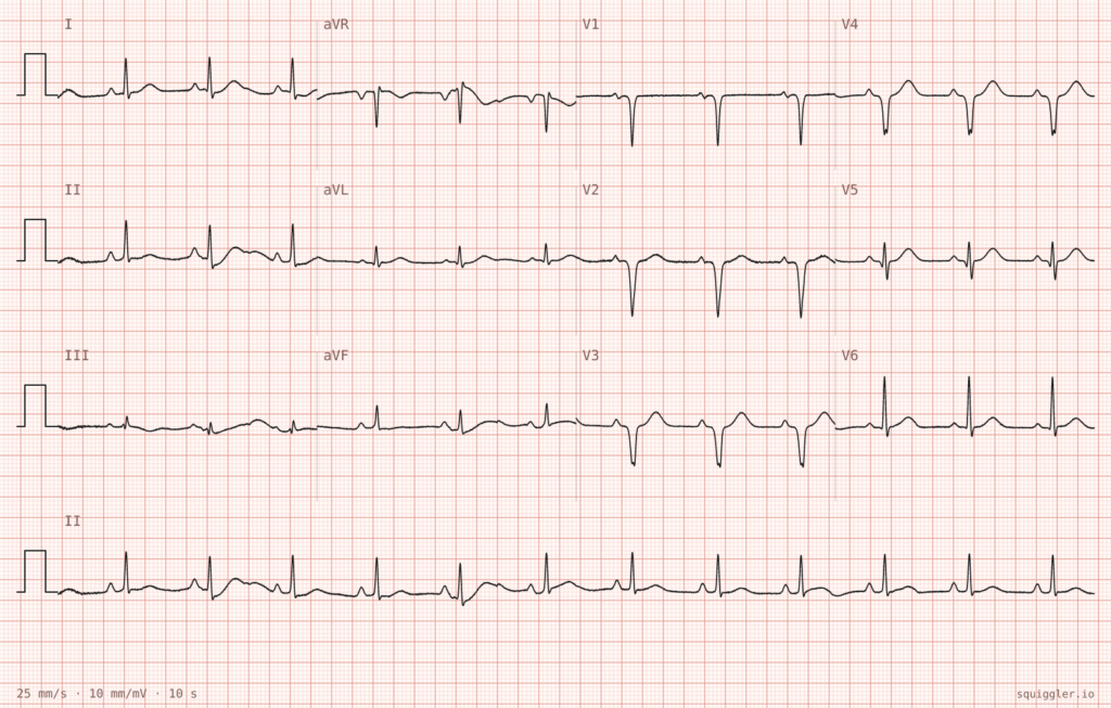ECG Case 139 dizzy post DCCV