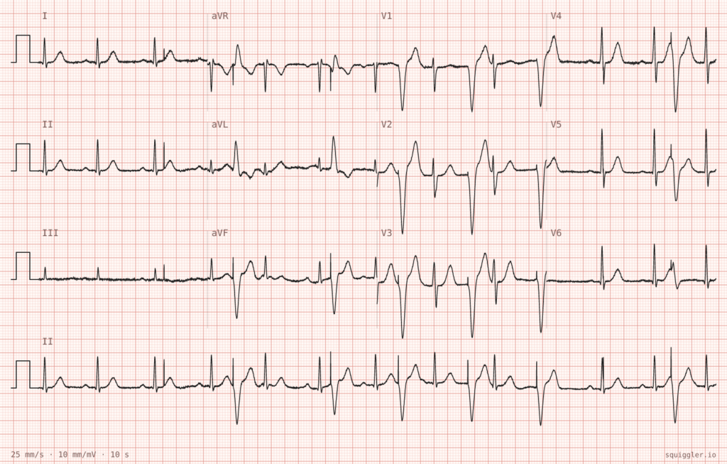 ECG Case 141 Palpitations and feeling unwell