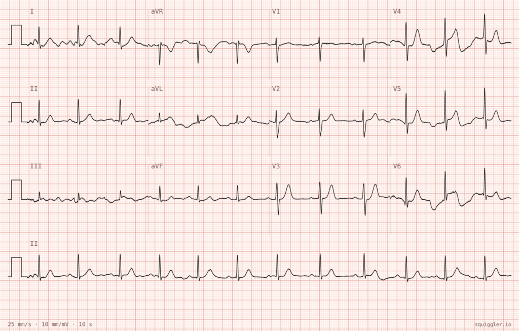 ECG Case 141 Palpitations and feeling unwell 2