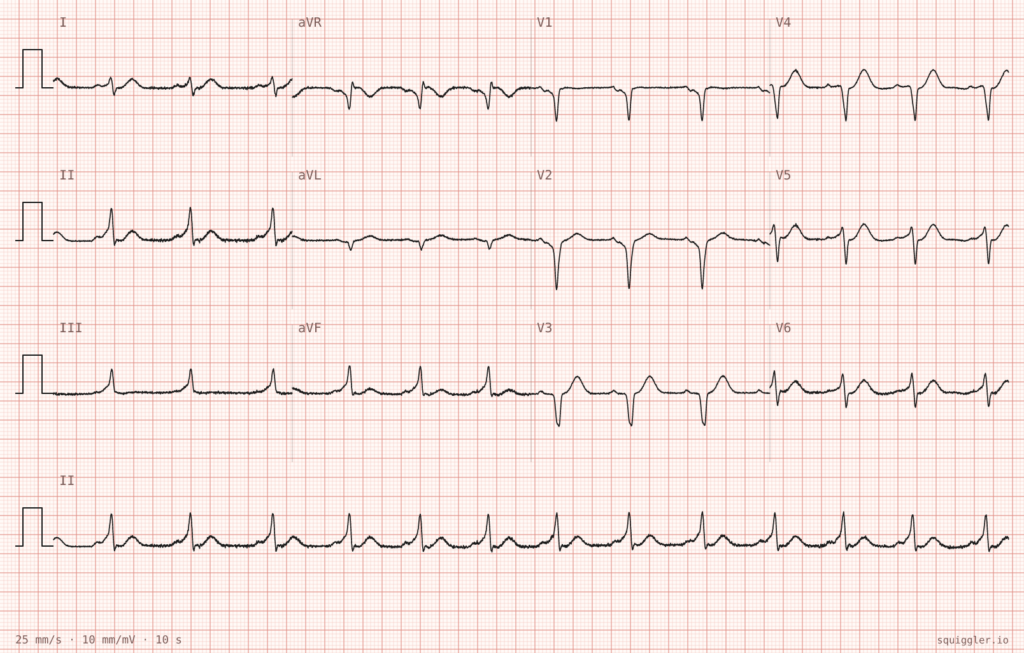 ECG case 140 routine screening ECG
