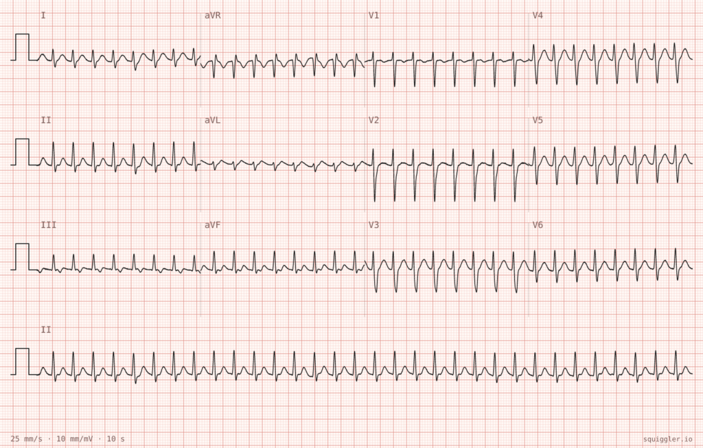 ECG case 140 routine screening ECG rapid